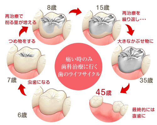 虫歯のサイクル