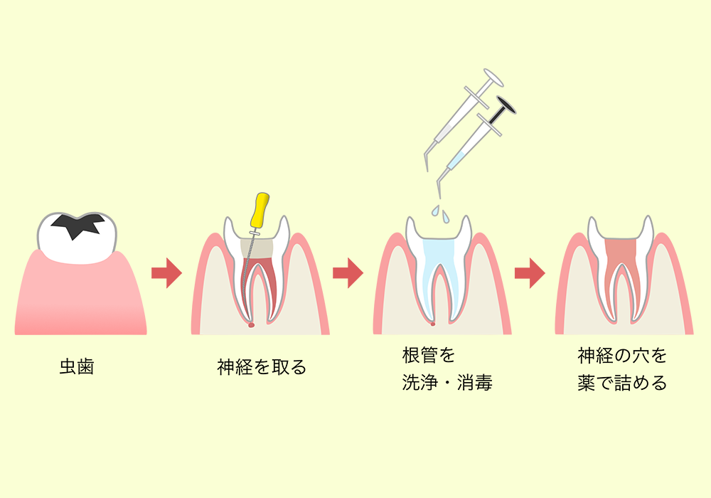 根管治療